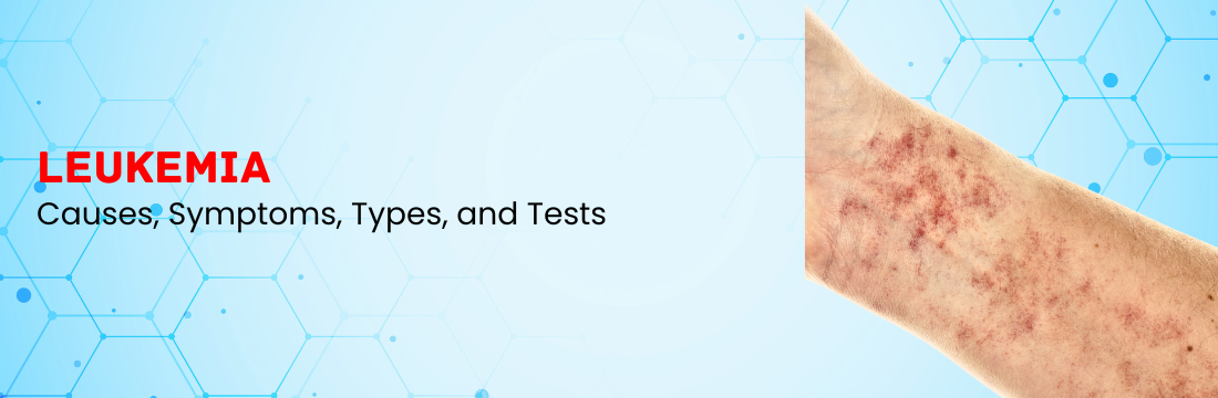 Leukemia: Causes, Symptoms, Types, and Tests